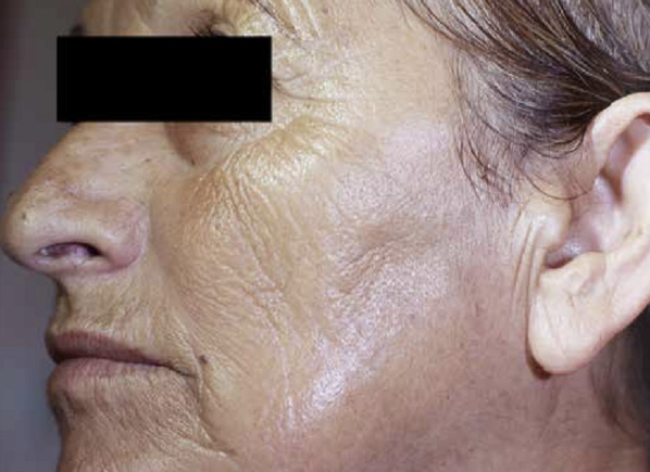 Frakcinis odos atnaujinimas - Prieš ir Po