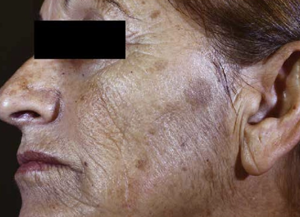 Frakcinis odos atnaujinimas - Prieš ir Po