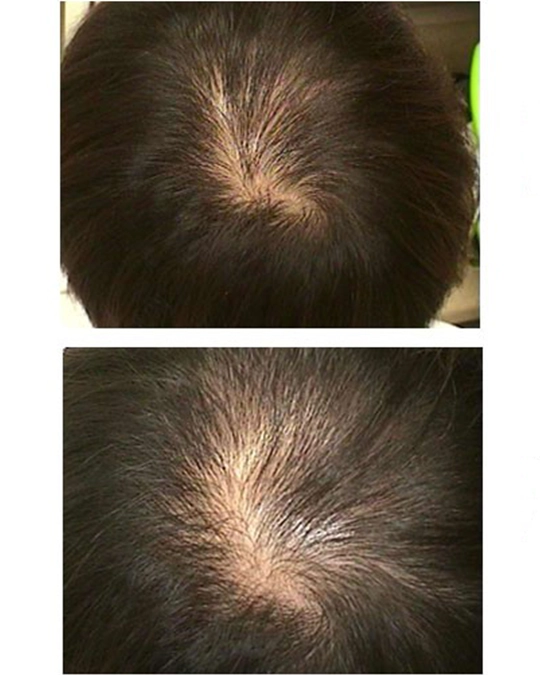 Hair filler before procedure