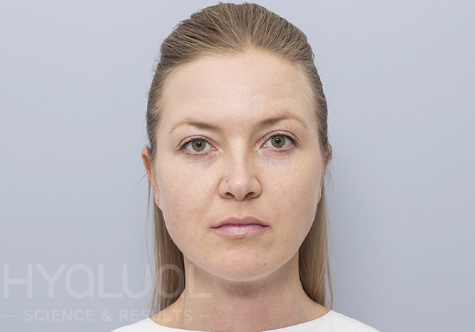 Odos švytėjimas po gintaro rūgšties injekcijų kurso