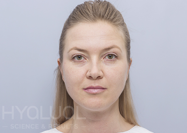 Odos būklė prieš gintaro rūgšties injekcijas