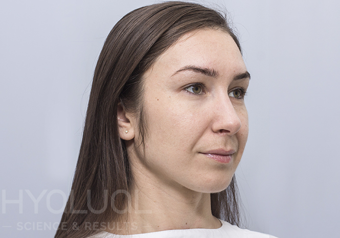 Švytinti ir akivaizdžiai stangresnė oda po gintaro rūgšties injekcijų.