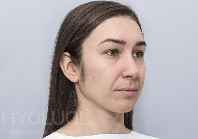 Prarastas odos stangrumas ir odos dehidratacija prieš gintaro rūgšties kursą