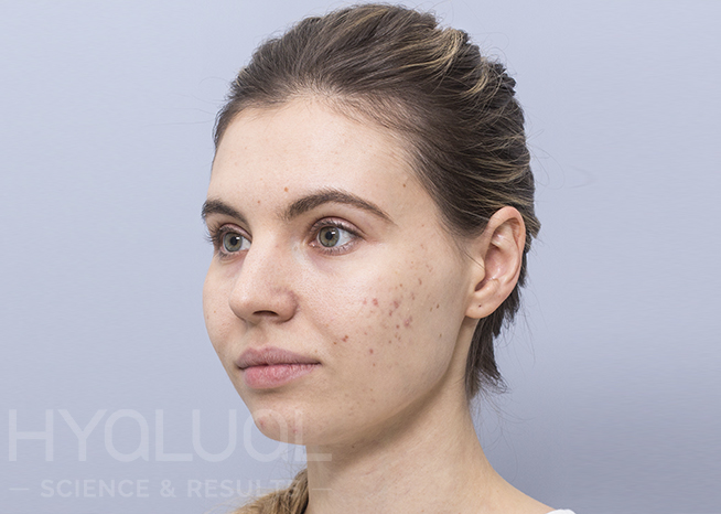 Papilkėjusi veido oda ir spuogai prieš redermalizaciją gintaro rūgštimi