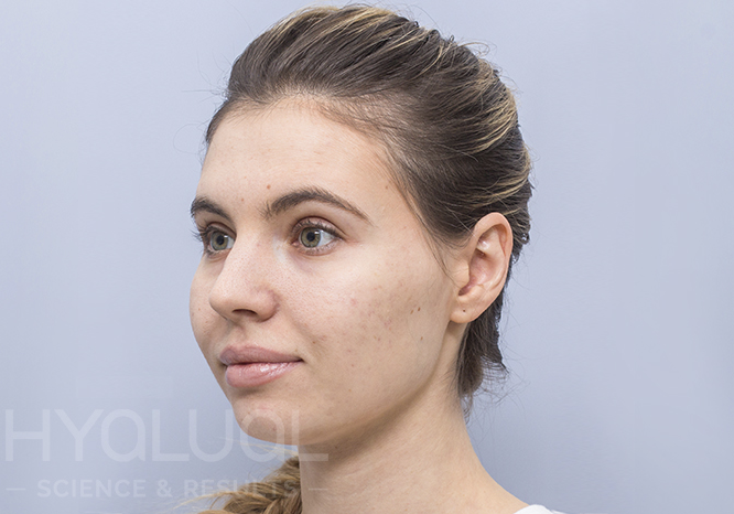 Skaisti ir sudrėkinta oda po gintaro rūgšties procedūros